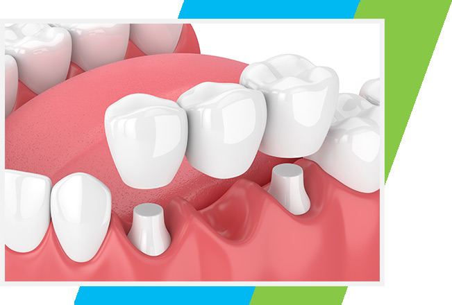 Dental Bridges West Airdrie Dental | General & Family Dentist | West Airdrie