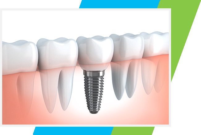 Dental Implants West Airdrie Dental | General & Family Dentist | West Airdrie