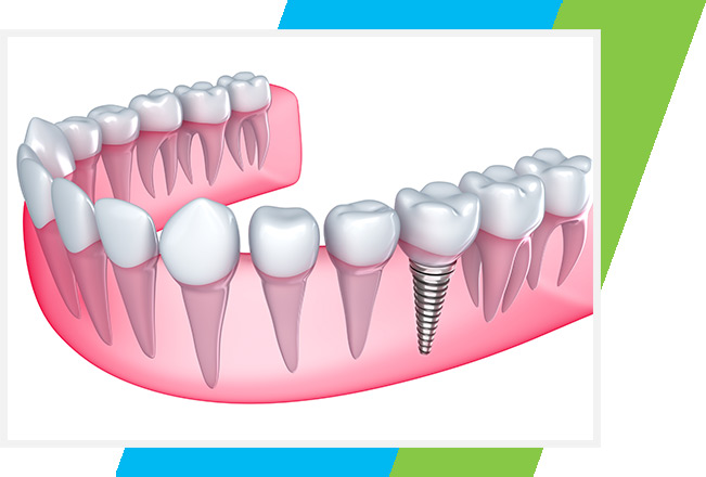 Dental Implants West Airdrie Dental | General & Family Dentist | West Airdrie
