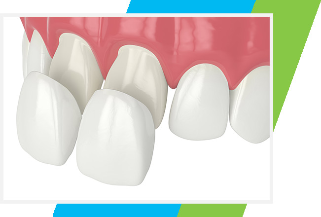 Porcelain Veneers West Airdrie Dental | General & Family Dentist | West Airdrie