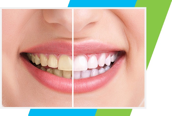 Teeth Whitening West Airdrie Dental | General & Family Dentist | West Airdrie