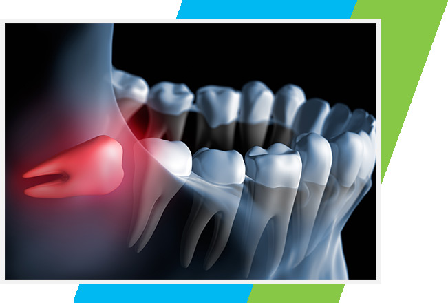 Wisdom Teeth Extraction West Airdrie Dental | General & Family Dentist | West Airdrie