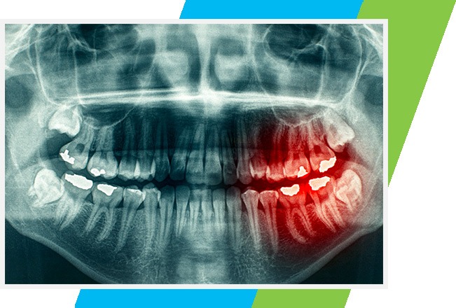 Wisdom Teeth Extraction West Airdrie Dental | General & Family Dentist | West Airdrie